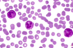 Human blood under a microscope showing three white blood cells surrounded by red blood cells.